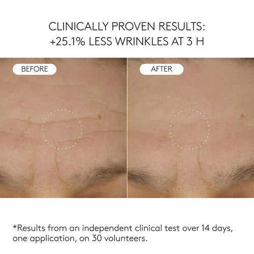 LUMÉVIA™ Blue Spicule Renewal Treatment